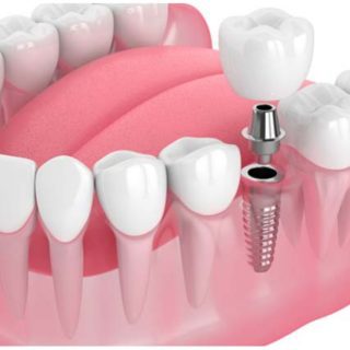 بدائل زراعة الأسنان