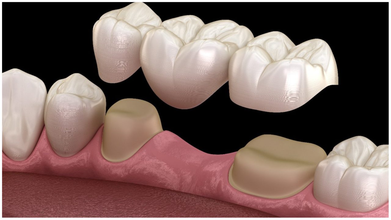 Fixed Dental Prosthesis