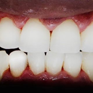 حشوات الكمبوزيت التجميلية