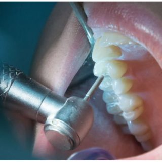 حشو جذور العصب