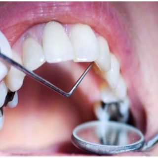 التهاب جذور الاعصاب