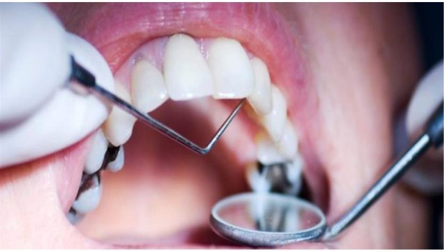 التهاب جذور الاعصاب