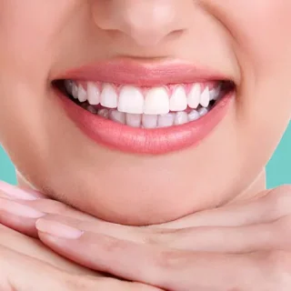 تجميل الأسنان بالفينير