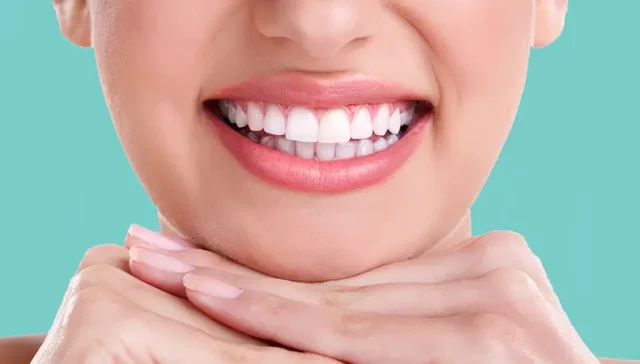 تجميل الأسنان بالفينير