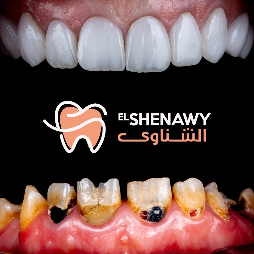 اسعار حشو العصب