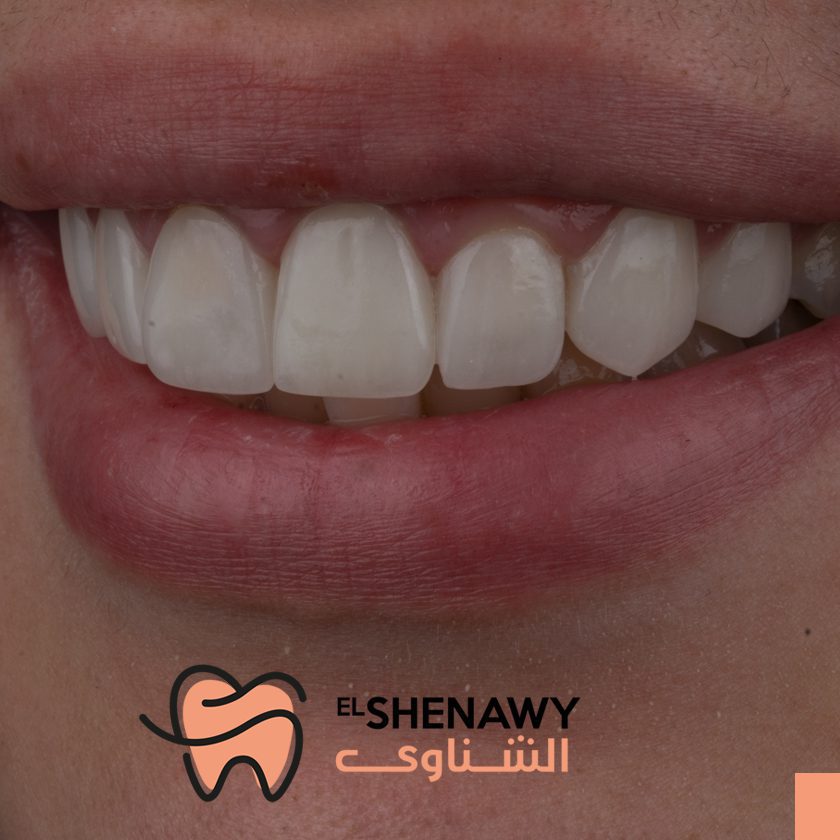 علاج جيوب اللثة بالليزر