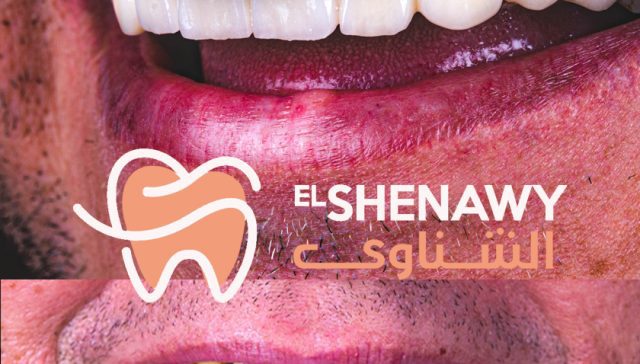 حشوات تجميلية لسد فراغات الاسنان