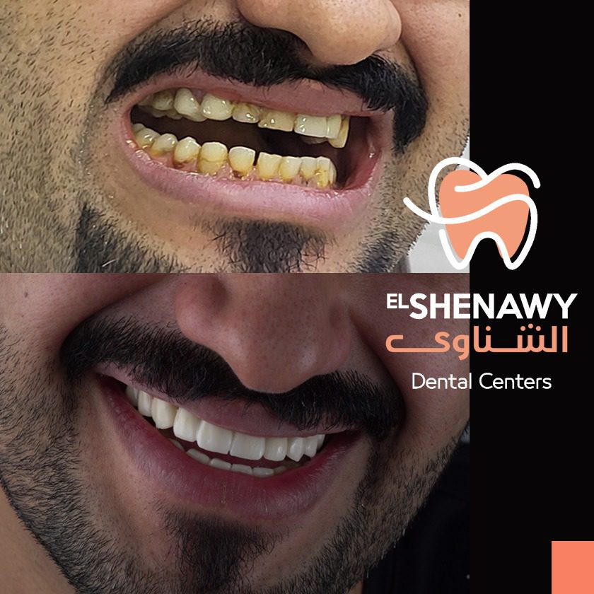 حشوة الكمبوزيت للاسنان الأمامية