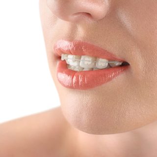 transparent orthodontics