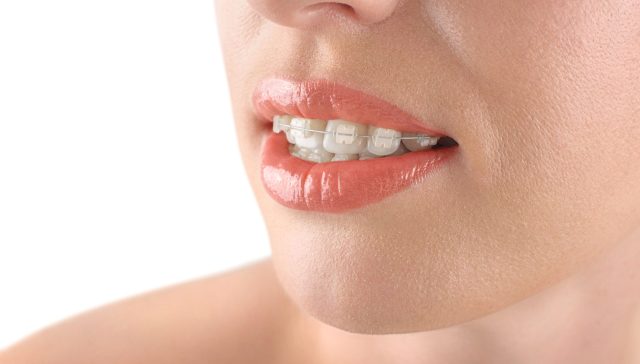 transparent orthodontics
