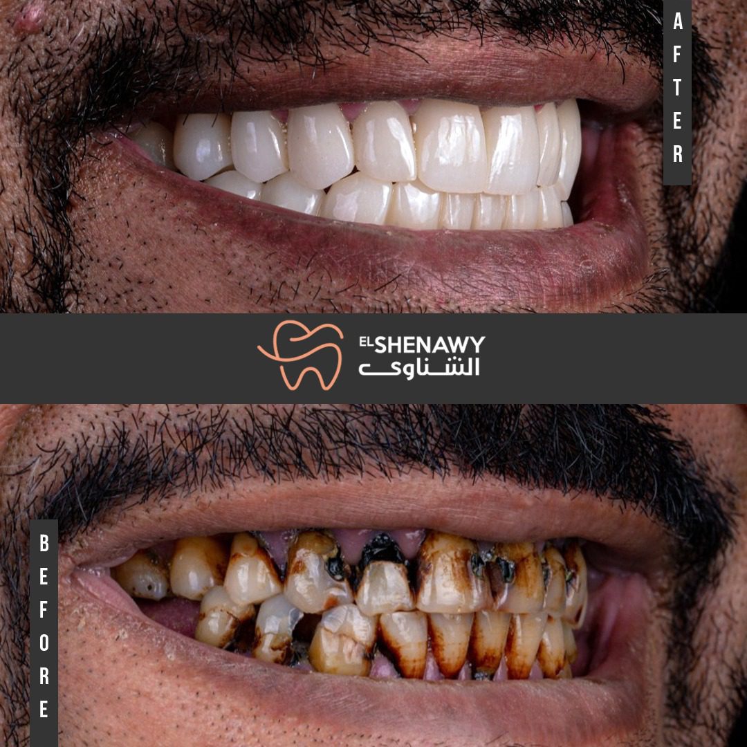 تركيب أسنان بالتقسيط في مصر