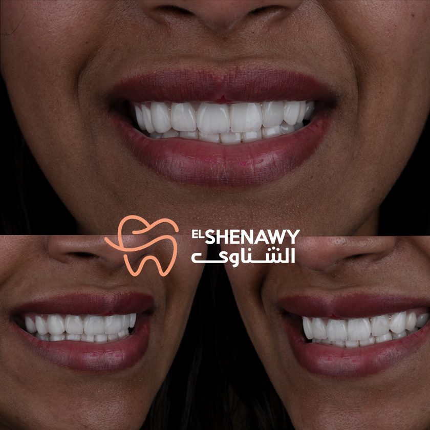 تجربتي مع زراعة الأسنان