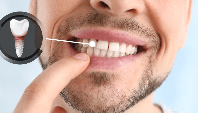 تكلفة زراعة الضرس في مصر