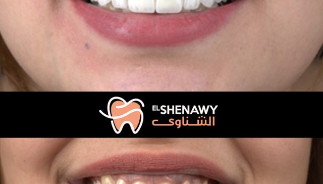 عدسات الأسنان اللومينير