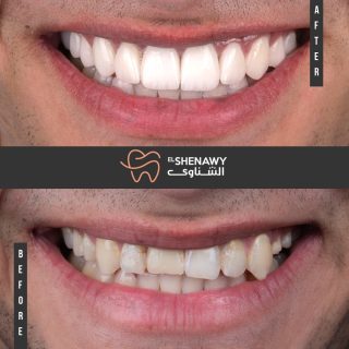 تكلفة فينير الاسنان في مصر