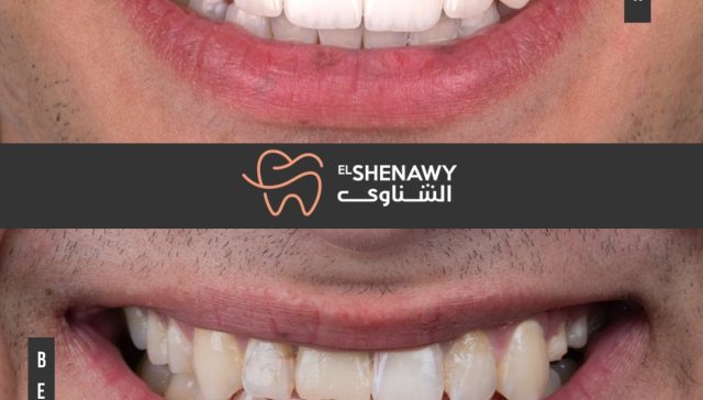 تكلفة فينير الاسنان في مصر