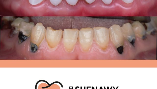 تجميل الاسنان قبل وبعد