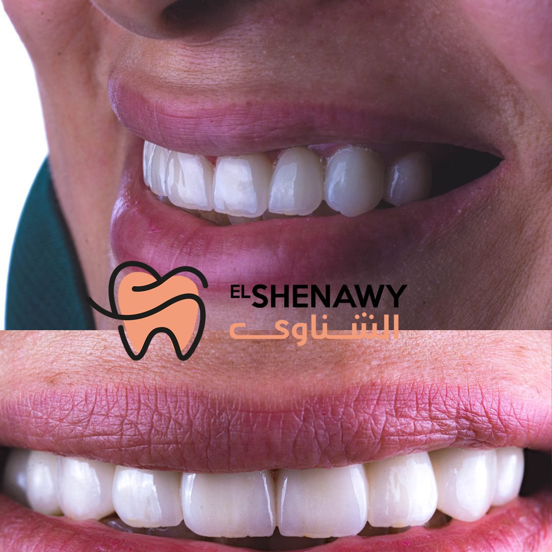 سعر كومبوزيت فينير