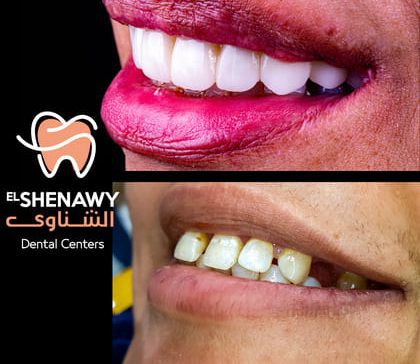 أنواع طربوش الاسنان