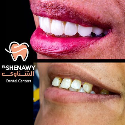 أنواع طربوش الاسنان