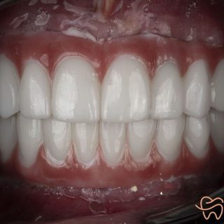 علاج الضحكة اللثوية