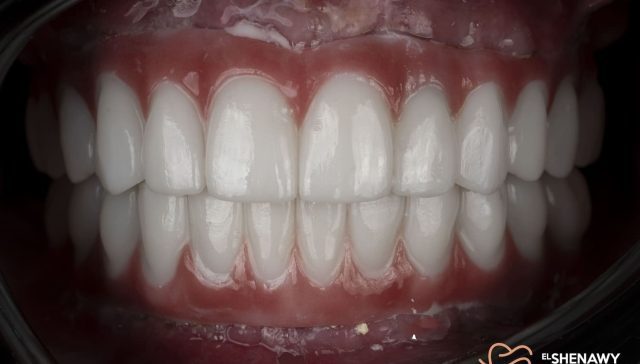 علاج الضحكة اللثوية