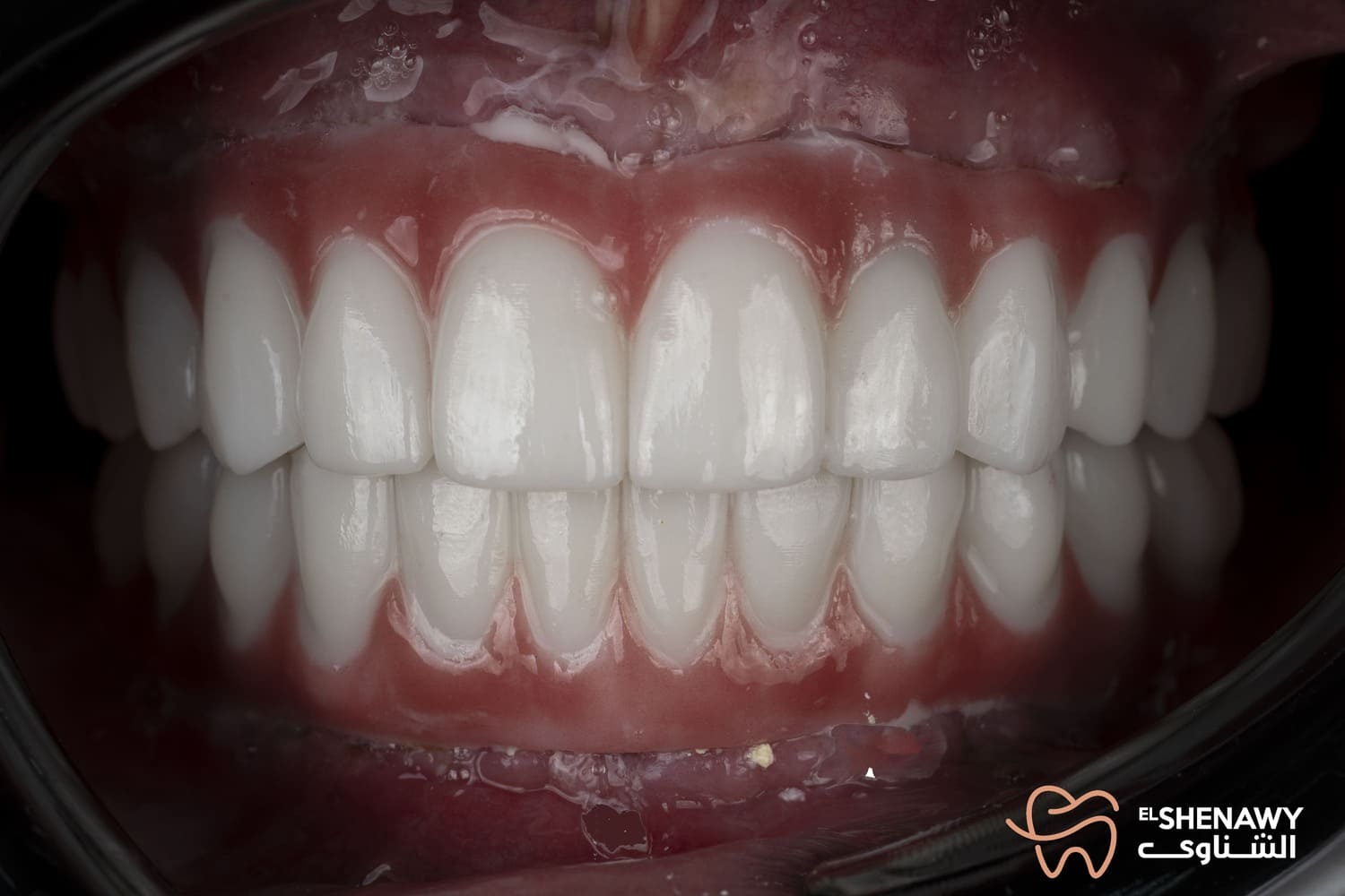 علاج الضحكة اللثوية