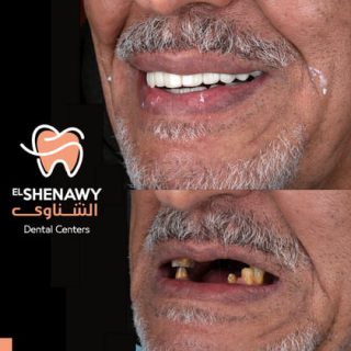 زراعة الاسنان الألمانية