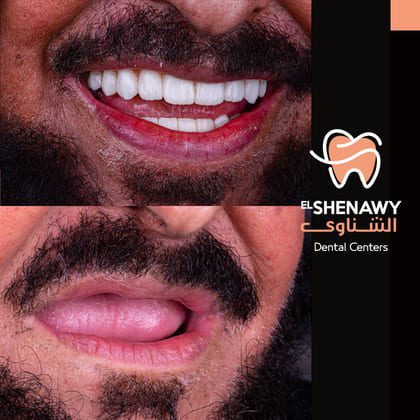 تكلفة زراعة طقم أسنان كامل