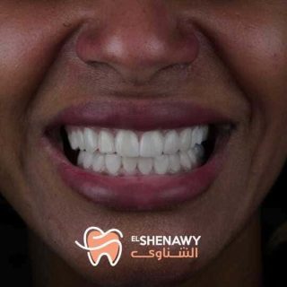 تكلفة زراعة الأسنان في مصر