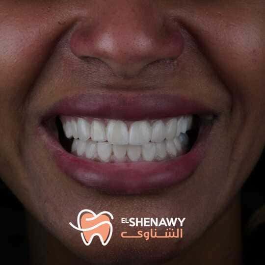 تكلفة زراعة الأسنان في مصر