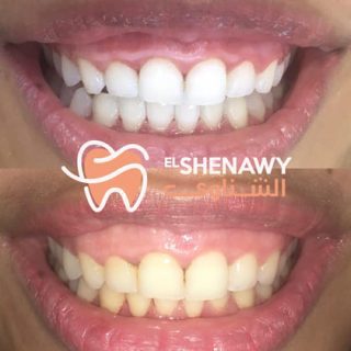 طريقة تنظيف الأسنان بالخيط