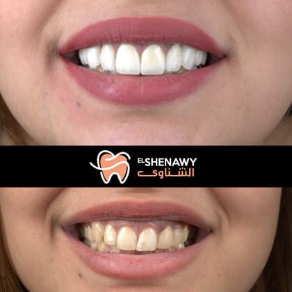 تجميل الأسنان الأمامية بدون تقويم