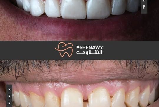 أنواع تجميل الأسنان