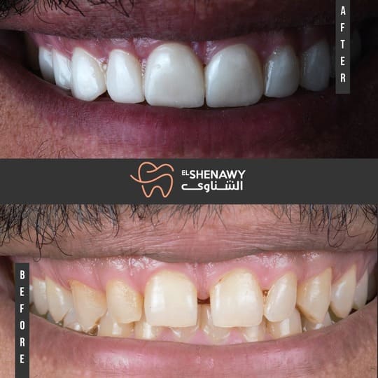 أنواع تجميل الأسنان