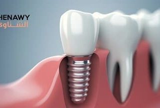 Dental implants without surgery