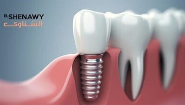 Dental implants without surgery