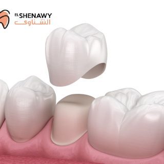 سعر طربوش الأسنان