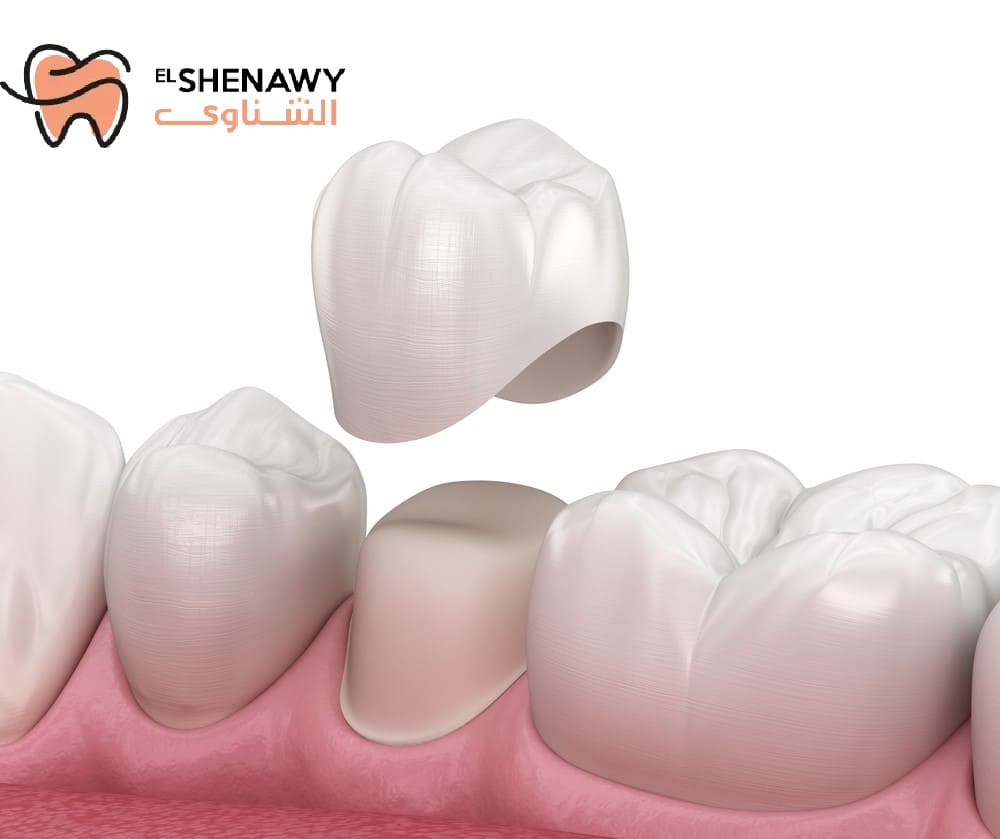 سعر طربوش الأسنان