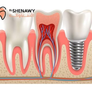 اضرار ترك الضرس بدون حشو