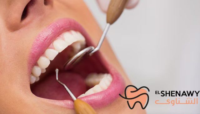 dental composite filling