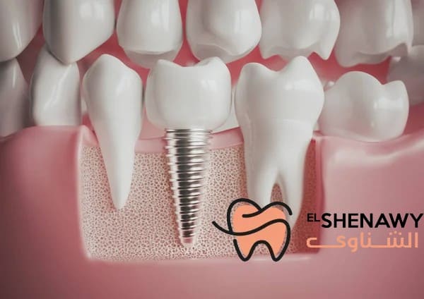 زراعة الاسنان قبل وبعد