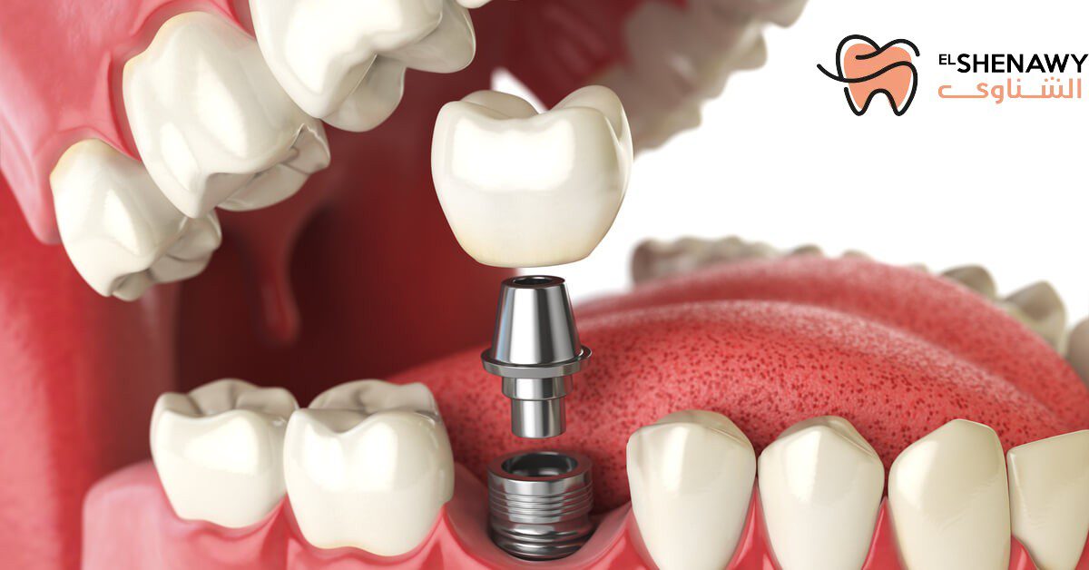زراعة الأسنان خطواتها وشروطها وافضل دكتور زراعة اسنان في مصر