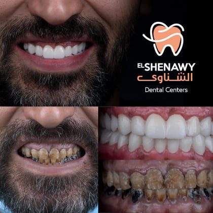 تسوس جذور الأسنان