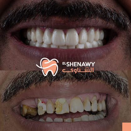 اسعار تركيب الأسنان الزيركون