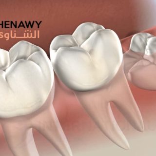 ضرس العقل المدفون