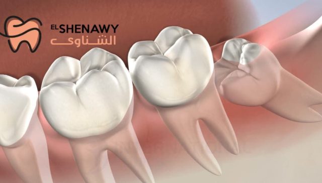 ضرس العقل المدفون