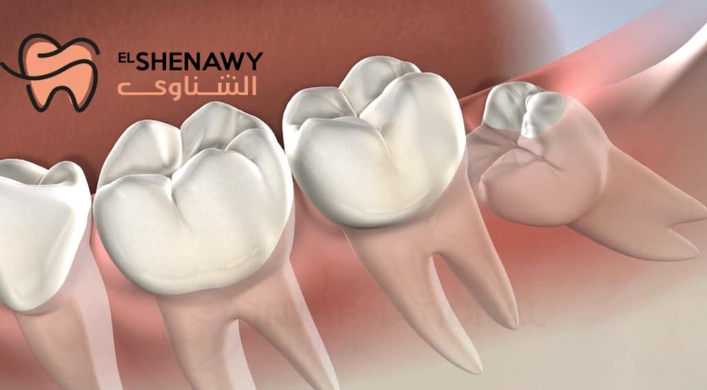 ضرس العقل المدفون