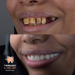 تجميل الاسنان قبل وبعد