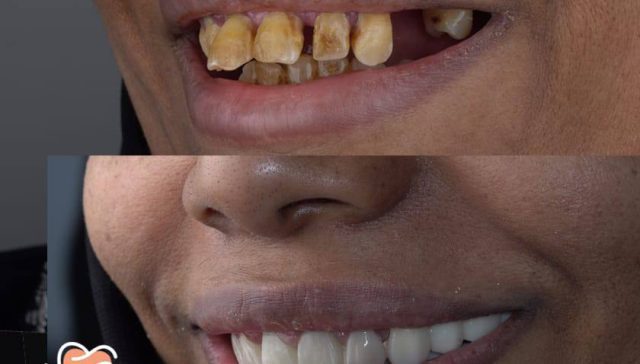 تجميل الاسنان قبل وبعد